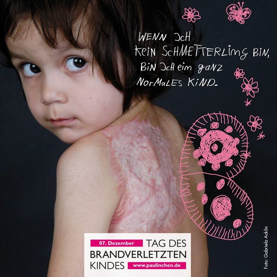 Paulinchen 2022 Tag des verbrannten Kindes - Foto: Gabriela Acklin Paulinchen 2022 Tag des verbrannten Kindes